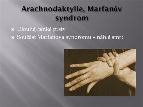 Arachnodaktylie - typický projev Marfanova syndromu