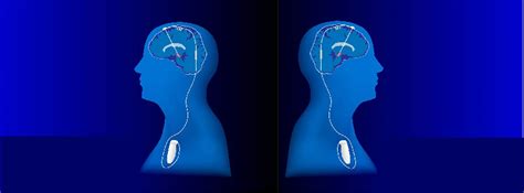 Hluboká mozková stimulace (DBS)