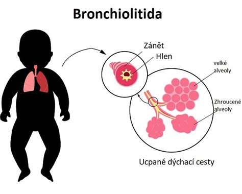 Příznaky akutní bronchitidy