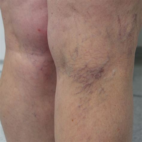 Sklerotizace metličkových varixů